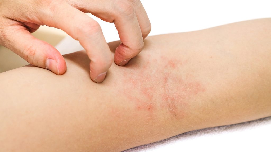 eczema sec