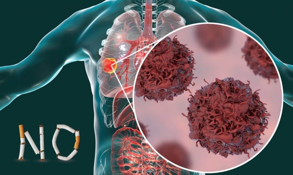 Le tabac et autres facteurs de risques du cancer du poumon